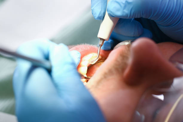 Best Emergency Tooth Extraction in Nashville, NC